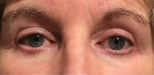 Blepharoplasty All 4 Eyelids