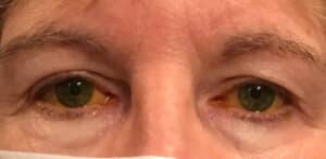 Blepharoplasty All 4 Eyelids