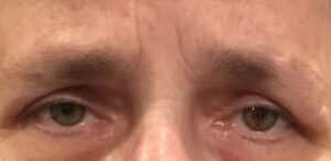 Upper Eyelid Blepharoplasty