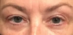 Cosmetic Lower Eyelid Blepharoplasty