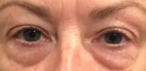 Cosmetic Lower Eyelid Blepharoplasty