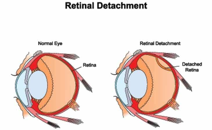 detached retina