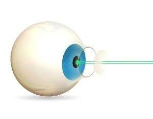 illustration of eyeball in cataract surgery
