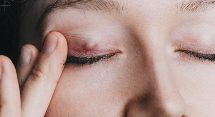 What Is a Chalazion? 65b8040f898dc.png
